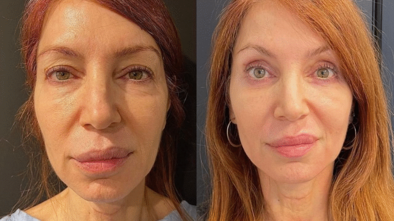 Blepharoplasty Explained: Everything You Need to Know Before Eyelid Surgery